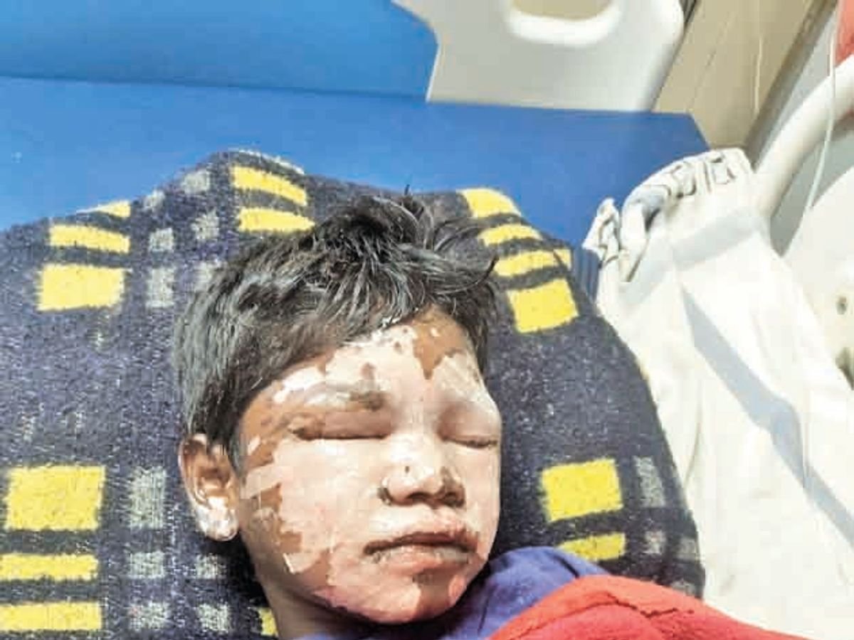 छात्रावास में नाबालिग छात्र खुद बना रहा था भोजन, खौलते तेल से बुरी तरह झुलसा छात्रावास में नाबालिग छात्र खुद बना रहा था भोजन, खौलते तेल से बुरी तरह झुलसा